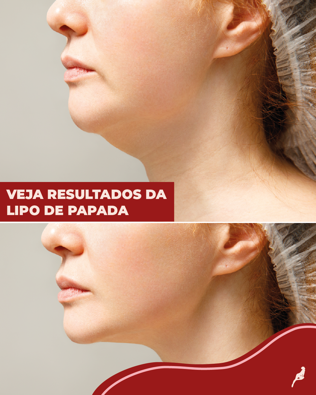 imagem de antes e depois da lipo de papada